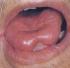 Significado de lengua con saburra pelada. MTC